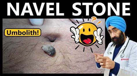 navel stone symptoms|Everything To Know About Umbolith Or Navel Stone:。